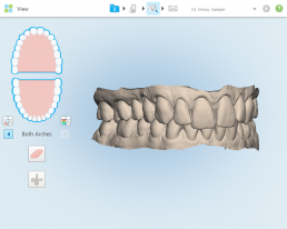 why-youre-likely-an-ideal-candidate-for-invisalign-3d-model-2